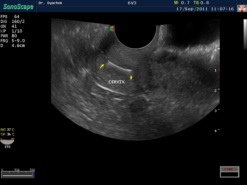Канал узи. Поперечный срез матки УЗИ. Цервикальный канал на УЗИ.
