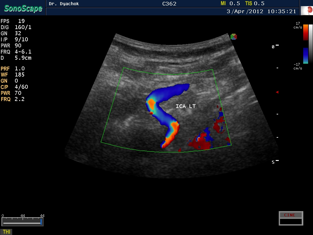 Эхограмма. Доплер сосудов брюшной полости. SONOSCAPE a5. Триплексное исследование сосудов изображения.